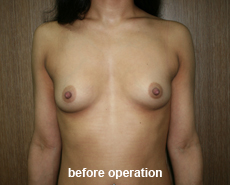 plastic-surgery-breast-augmentation